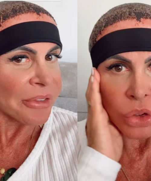 Gretchen compartilha novidades sobre sua recuperação após o transplante de cabelo