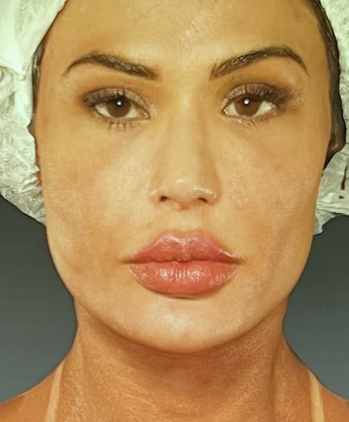 Gracyanne Barbosa comemora avanço na recuperação do joelho um ano após a cirurgia